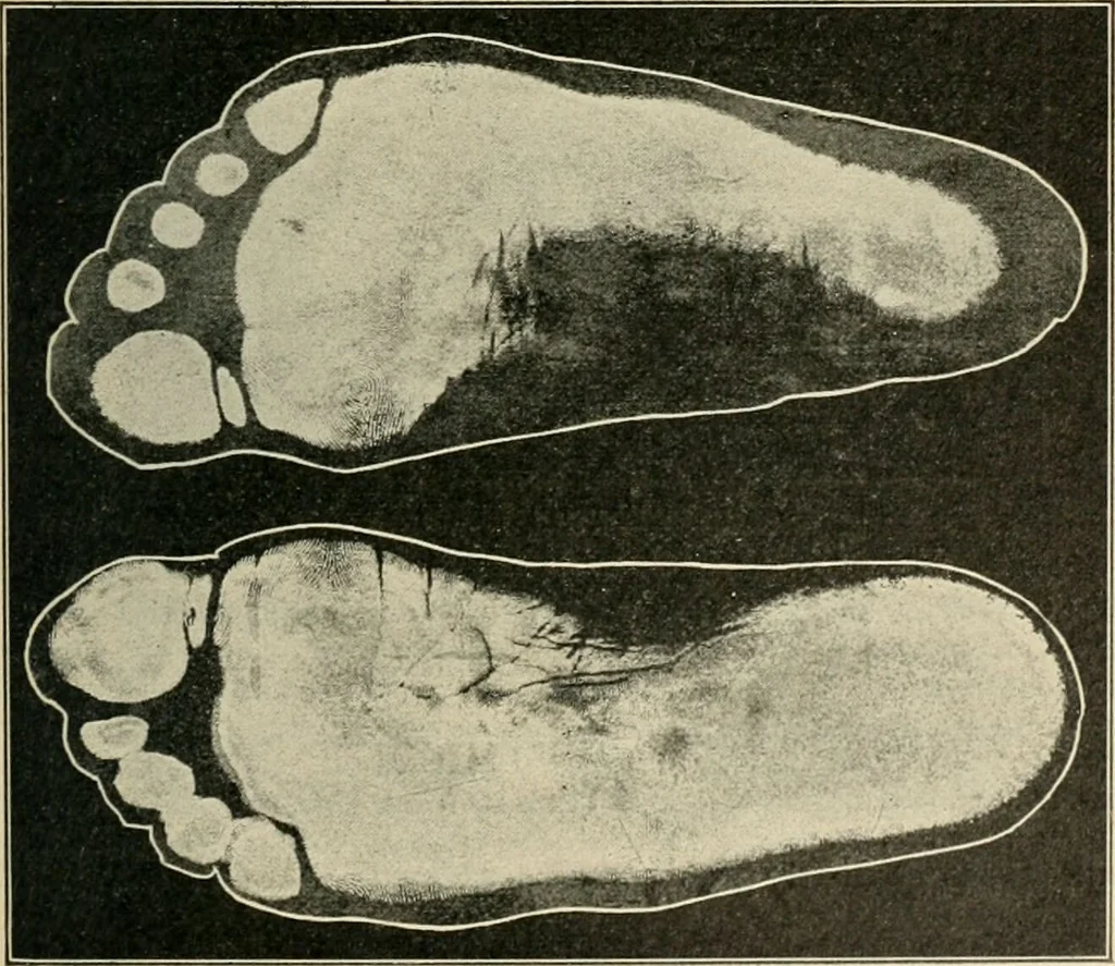 An illustration from Atlas and epitome of diseases caused by accidents / by Dr. Ed. Golebiewski ... authorized translation from the German, with editorial notes and additions by Pearce Bailey ... 40 colored plates, and 143 illustrations in black., 1900, leaf 573