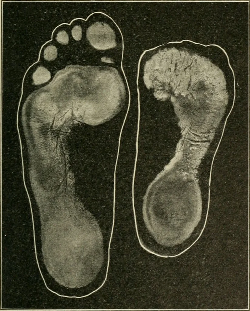 An illustration from Atlas and epitome of diseases caused by accidents / by Dr. Ed. Golebiewski ... authorized translation from the German, with editorial notes and additions by Pearce Bailey ... 40 colored plates, and 143 illustrations in black., 1900, leaf 593