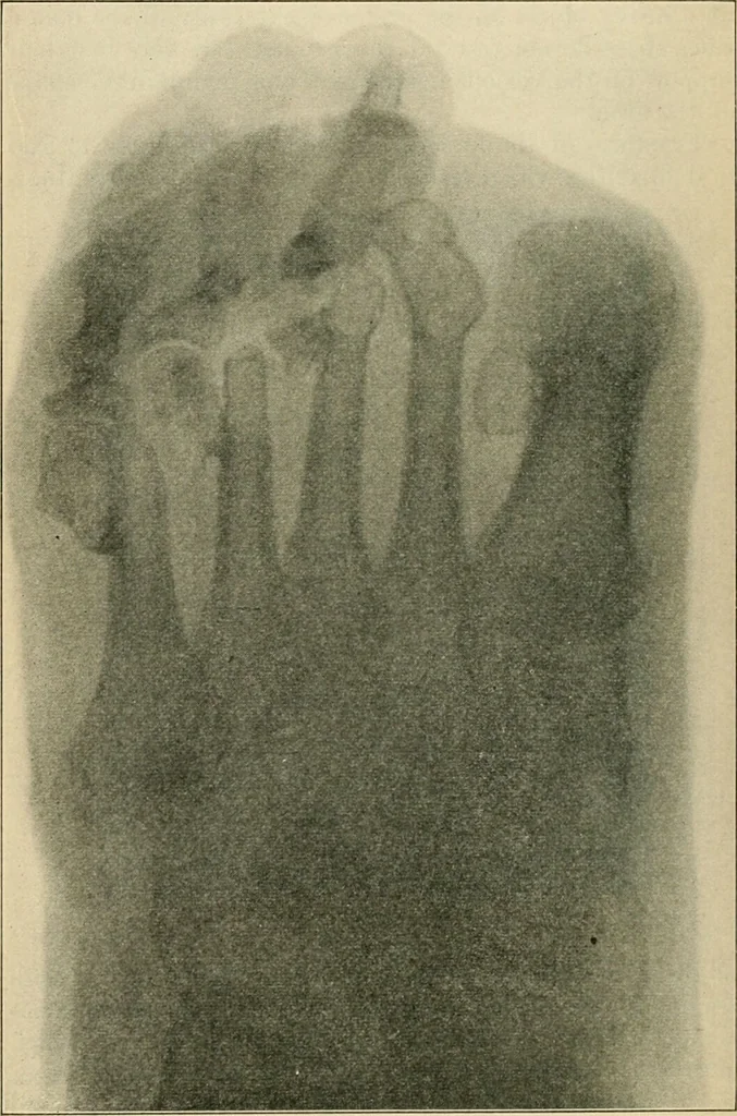 An illustration from Atlas and epitome of diseases caused by accidents / by Dr. Ed. Golebiewski ... authorized translation from the German, with editorial notes and additions by Pearce Bailey ... 40 colored plates, and 143 illustrations in black., 1900, leaf 594