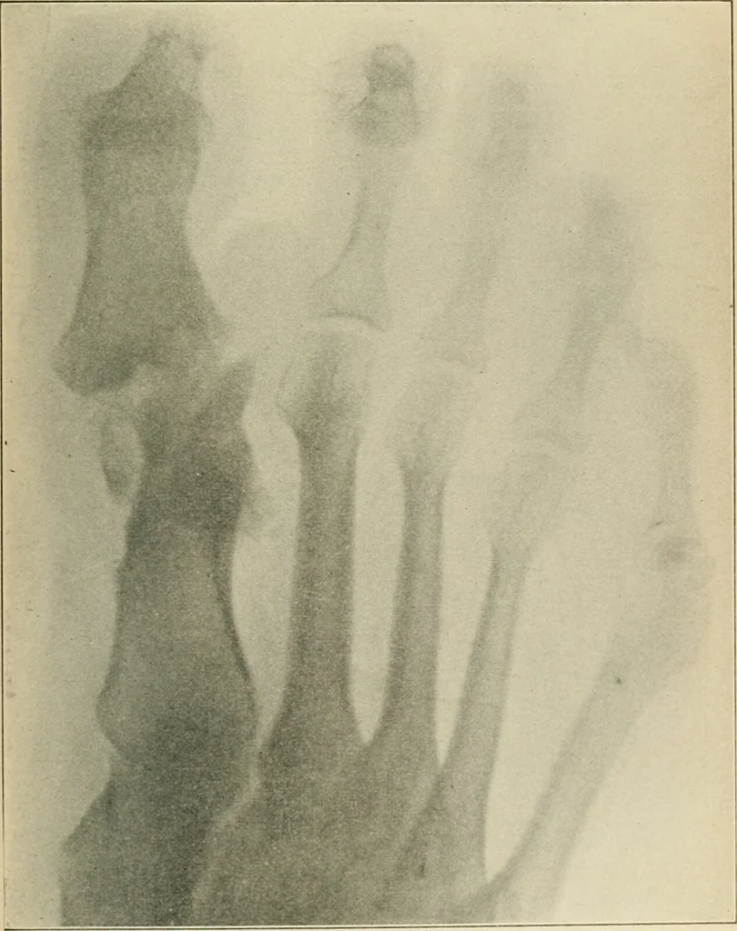 An illustration from Atlas and epitome of diseases caused by accidents / by Dr. Ed. Golebiewski ... authorized translation from the German, with editorial notes and additions by Pearce Bailey ... 40 colored plates, and 143 illustrations in black., 1900, leaf 597