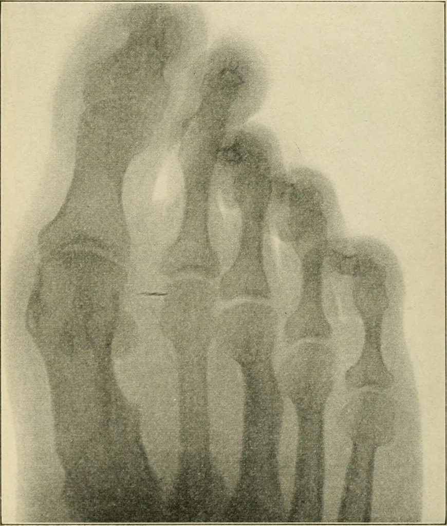 An illustration from Atlas and epitome of diseases caused by accidents / by Dr. Ed. Golebiewski ... authorized translation from the German, with editorial notes and additions by Pearce Bailey ... 40 colored plates, and 143 illustrations in black., 1900, leaf 598