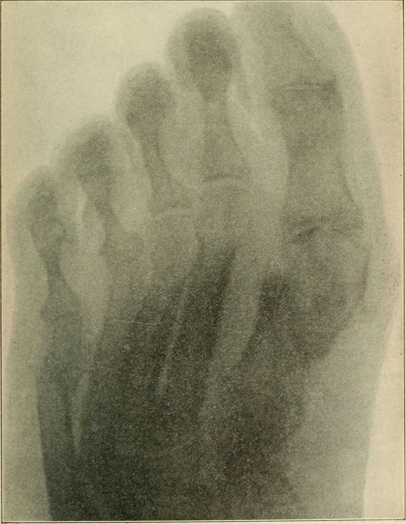 An illustration from Atlas and epitome of diseases caused by accidents / by Dr. Ed. Golebiewski ... authorized translation from the German, with editorial notes and additions by Pearce Bailey ... 40 colored plates, and 143 illustrations in black., 1900, leaf 599