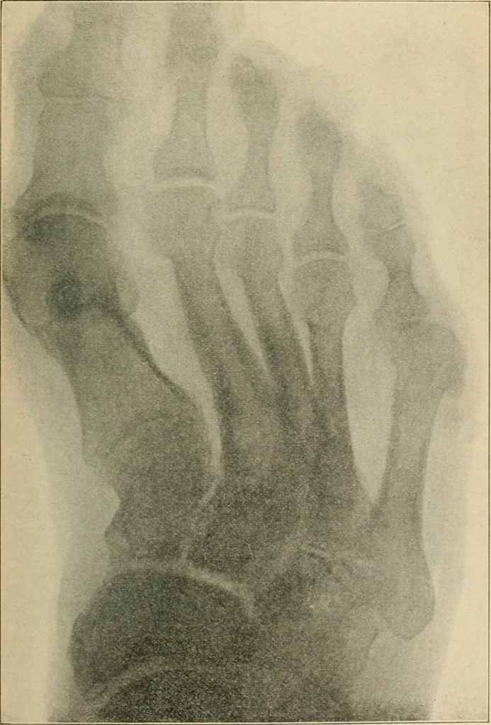 An illustration from Atlas and epitome of diseases caused by accidents / by Dr. Ed. Golebiewski ... authorized translation from the German, with editorial notes and additions by Pearce Bailey ... 40 colored plates, and 143 illustrations in black., 1900, leaf 601