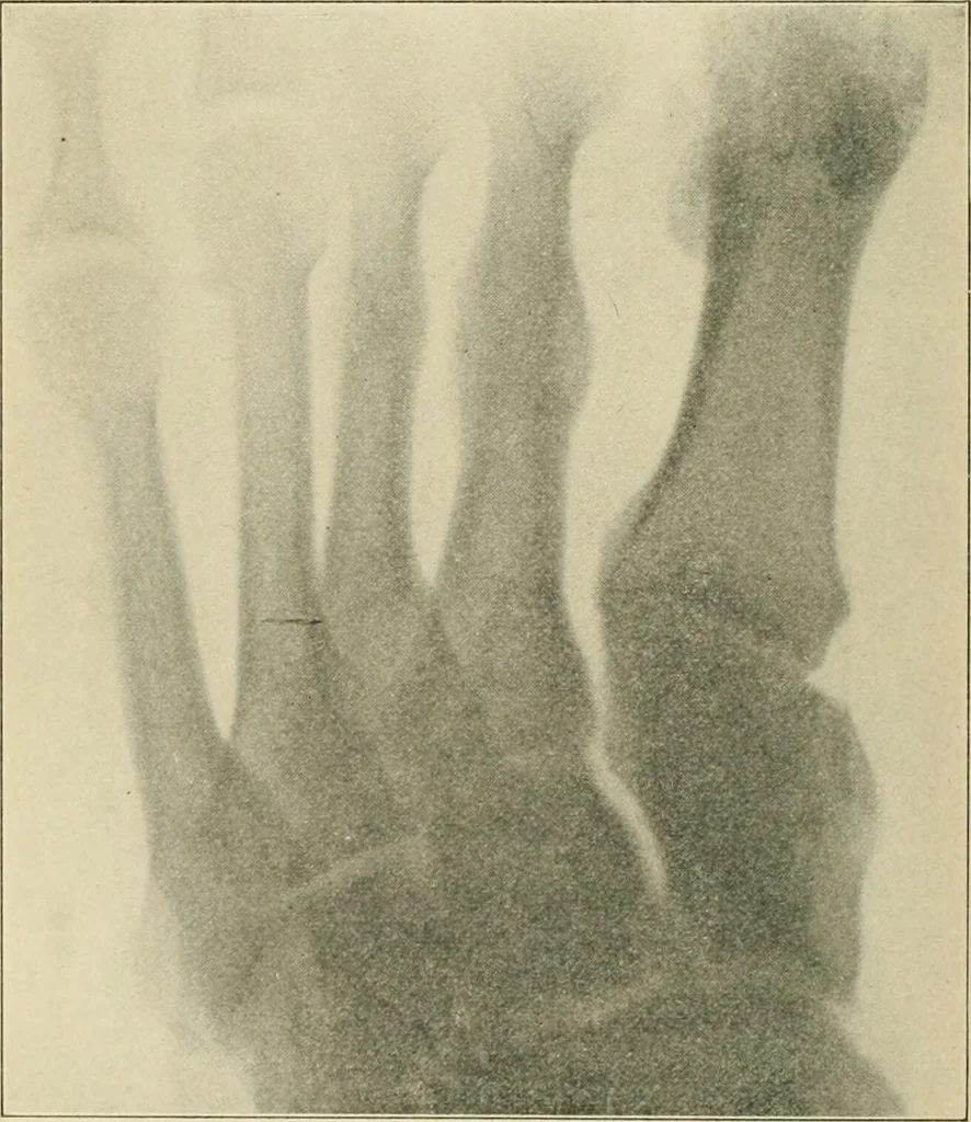 An illustration from Atlas and epitome of diseases caused by accidents / by Dr. Ed. Golebiewski ... authorized translation from the German, with editorial notes and additions by Pearce Bailey ... 40 colored plates, and 143 illustrations in black., 1900, leaf 602