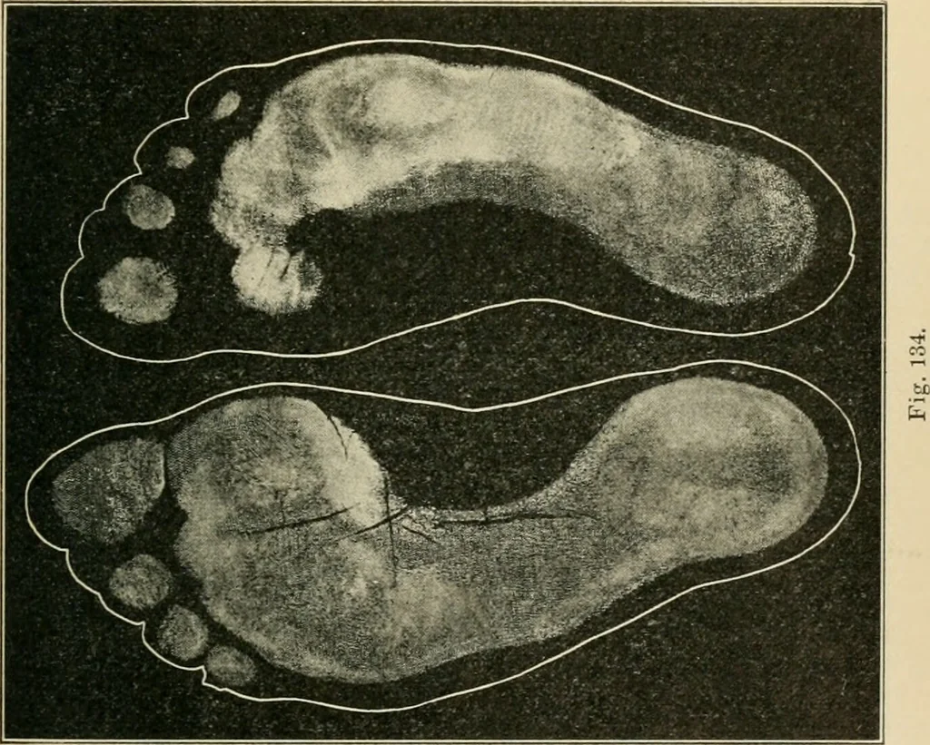 An illustration from Atlas and epitome of diseases caused by accidents / by Dr. Ed. Golebiewski ... authorized translation from the German, with editorial notes and additions by Pearce Bailey ... 40 colored plates, and 143 illustrations in black., 1900, leaf 607
