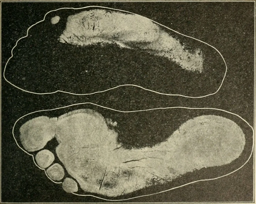 An illustration from Atlas and epitome of diseases caused by accidents / by Dr. Ed. Golebiewski ... authorized translation from the German, with editorial notes and additions by Pearce Bailey ... 40 colored plates, and 143 illustrations in black., 1900, leaf 607