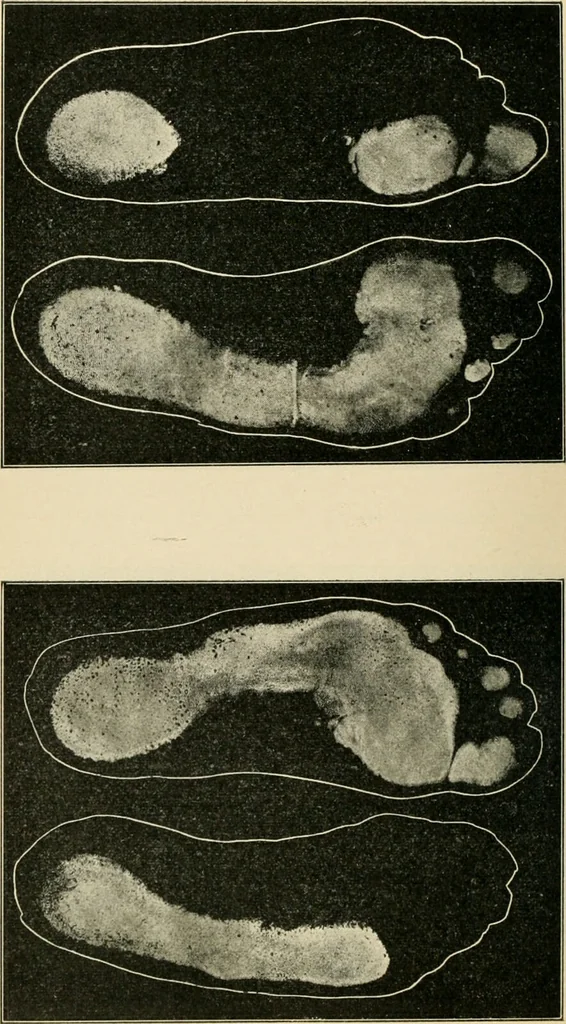 An illustration from Atlas and epitome of diseases caused by accidents / by Dr. Ed. Golebiewski ... authorized translation from the German, with editorial notes and additions by Pearce Bailey ... 40 colored plates, and 143 illustrations in black., 1900, leaf 608