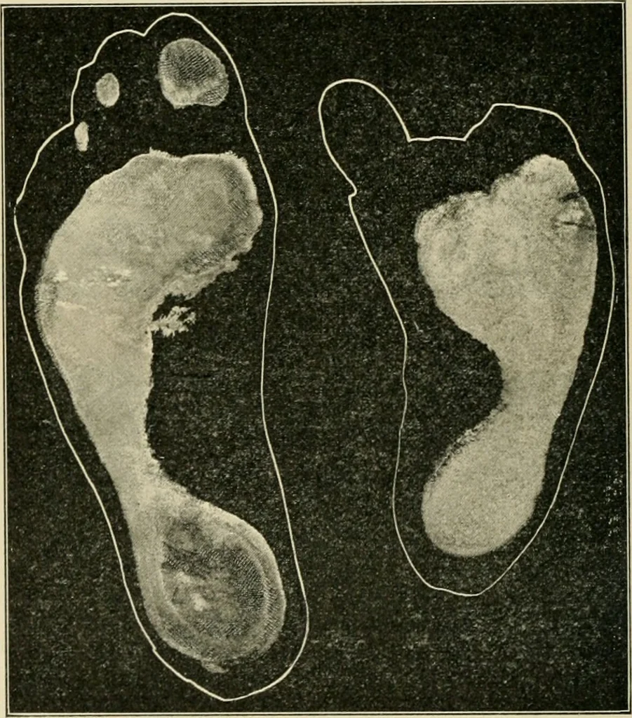 An illustration from Atlas and epitome of diseases caused by accidents / by Dr. Ed. Golebiewski ... authorized translation from the German, with editorial notes and additions by Pearce Bailey ... 40 colored plates, and 143 illustrations in black., 1900, leaf 616