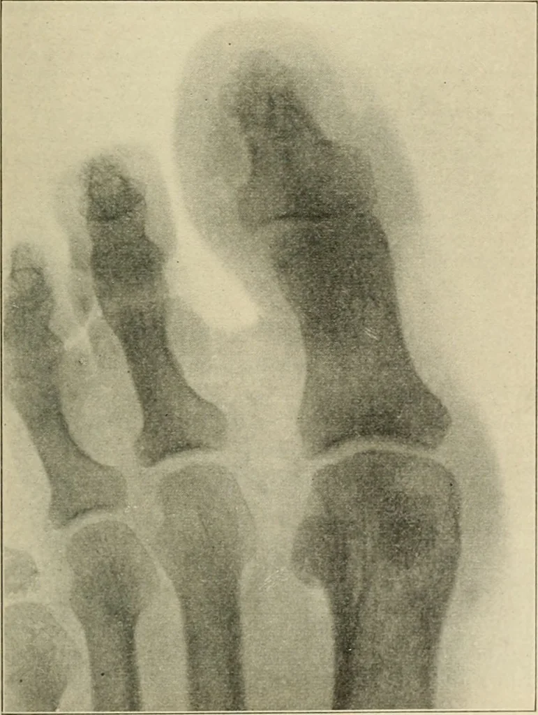 An illustration from Atlas and epitome of diseases caused by accidents / by Dr. Ed. Golebiewski ... authorized translation from the German, with editorial notes and additions by Pearce Bailey ... 40 colored plates, and 143 illustrations in black., 1900, leaf 619
