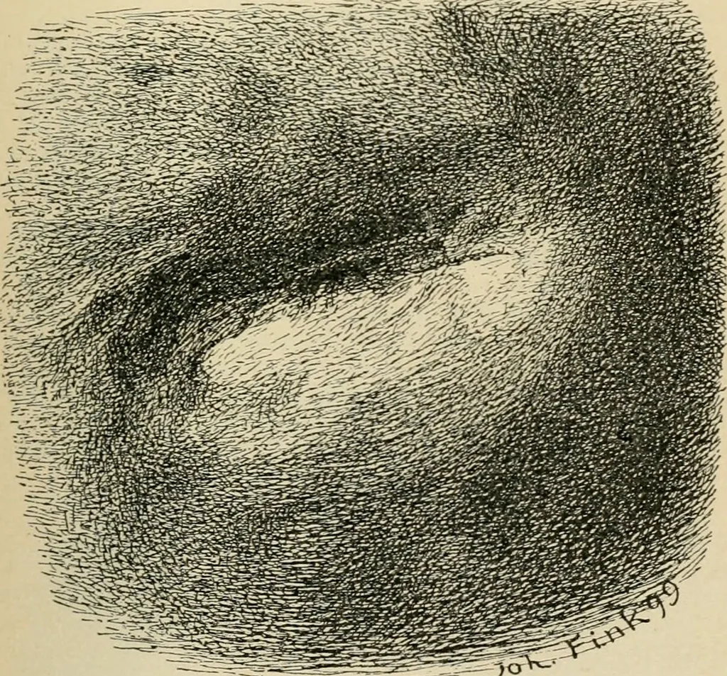 An illustration from Atlas and epitome of diseases caused by accidents / by Dr. Ed. Golebiewski ... authorized translation from the German, with editorial notes and additions by Pearce Bailey ... 40 colored plates, and 143 illustrations in black., 1900, leaf 93