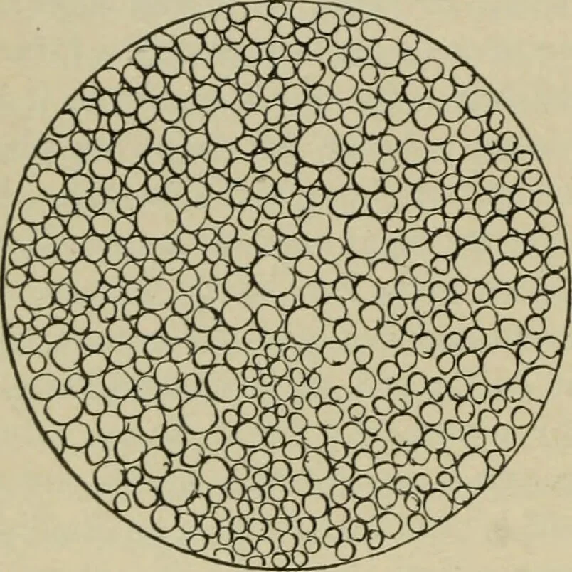 An illustration from Diseases of infancy and childhood, their dietetic, hygienic, and medical treatment : a text-book designed for practitioners and students in medicine / By Louis Fischer., 1910, leaf 108