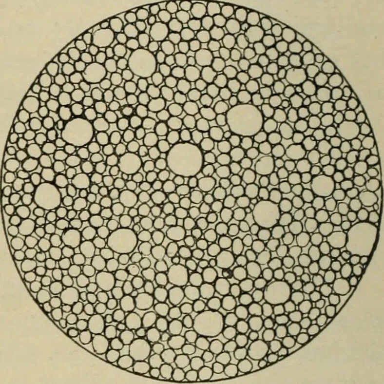 An illustration from Diseases of infancy and childhood, their dietetic, hygienic, and medical treatment : a text-book designed for practitioners and students in medicine / By Louis Fischer., 1910, leaf 108