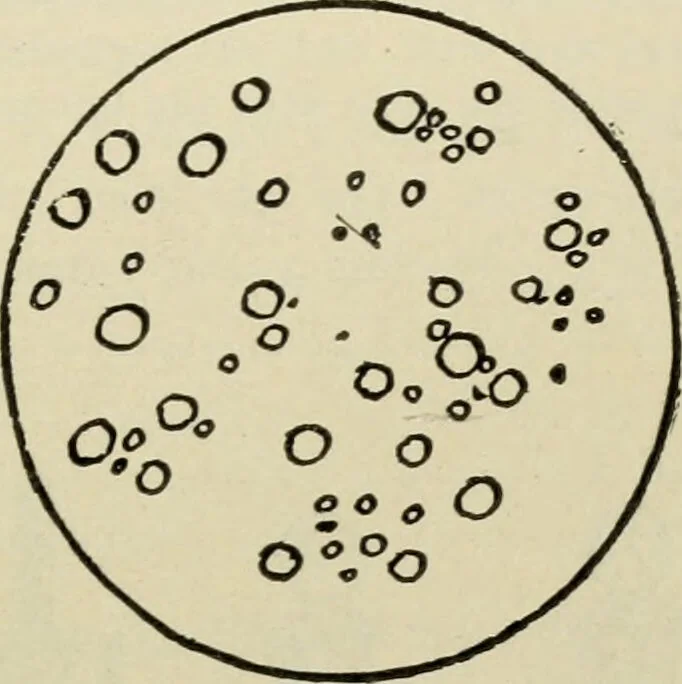 An illustration from Diseases of infancy and childhood, their dietetic, hygienic, and medical treatment : a text-book designed for practitioners and students in medicine / By Louis Fischer., 1910, leaf 115
