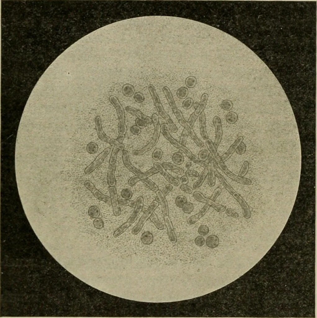 An illustration from Diseases of infancy and childhood, their dietetic, hygienic, and medical treatment : a text-book designed for practitioners and students in medicine / By Louis Fischer., 1910, leaf 268