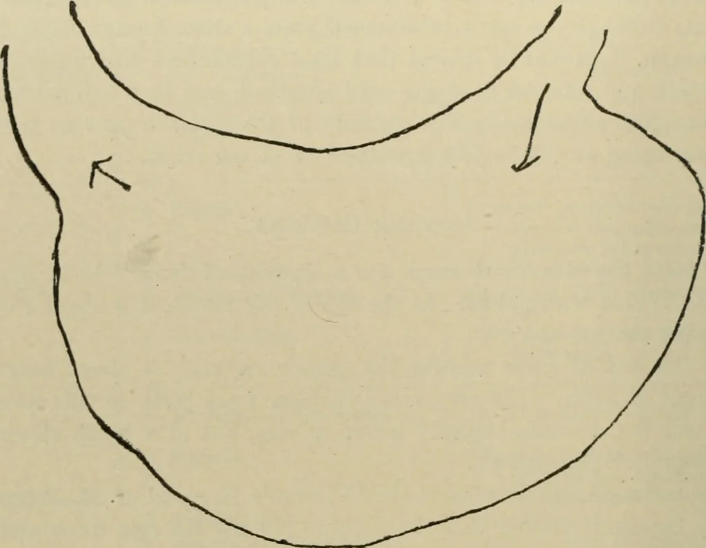 An illustration from Diseases of infancy and childhood, their dietetic, hygienic, and medical treatment : a text-book designed for practitioners and students in medicine / By Louis Fischer., 1910, leaf 286