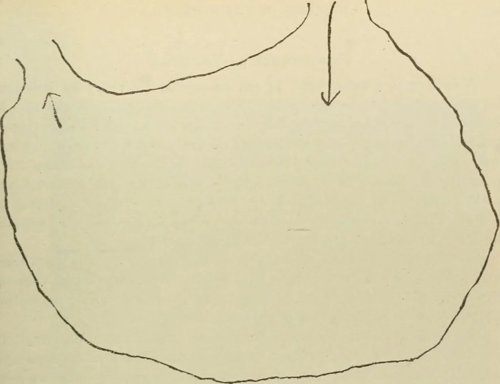 An illustration from Diseases of infancy and childhood, their dietetic, hygienic, and medical treatment : a text-book designed for practitioners and students in medicine / By Louis Fischer., 1910, leaf 287