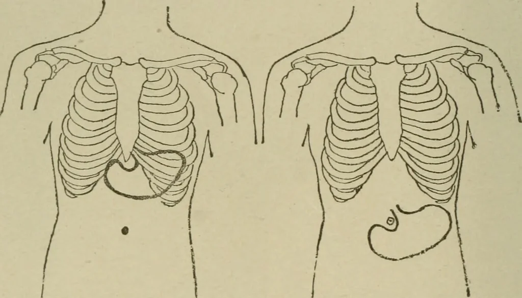 An illustration from Diseases of infancy and childhood, their dietetic, hygienic, and medical treatment : a text-book designed for practitioners and students in medicine / By Louis Fischer., 1910, leaf 310