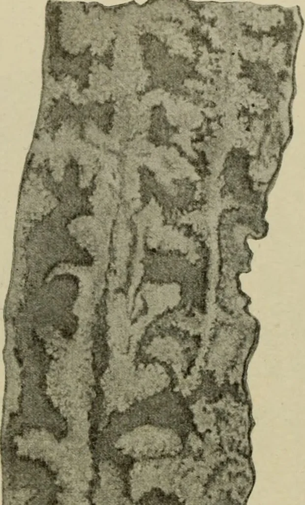 An illustration from Diseases of infancy and childhood, their dietetic, hygienic, and medical treatment : a text-book designed for practitioners and students in medicine / By Louis Fischer., 1910, leaf 336