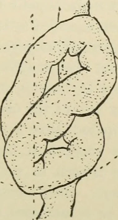 An illustration from Diseases of infancy and childhood, their dietetic, hygienic, and medical treatment : a text-book designed for practitioners and students in medicine / By Louis Fischer., 1910, leaf 343