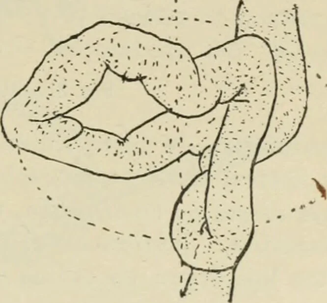 An illustration from Diseases of infancy and childhood, their dietetic, hygienic, and medical treatment : a text-book designed for practitioners and students in medicine / By Louis Fischer., 1910, leaf 343