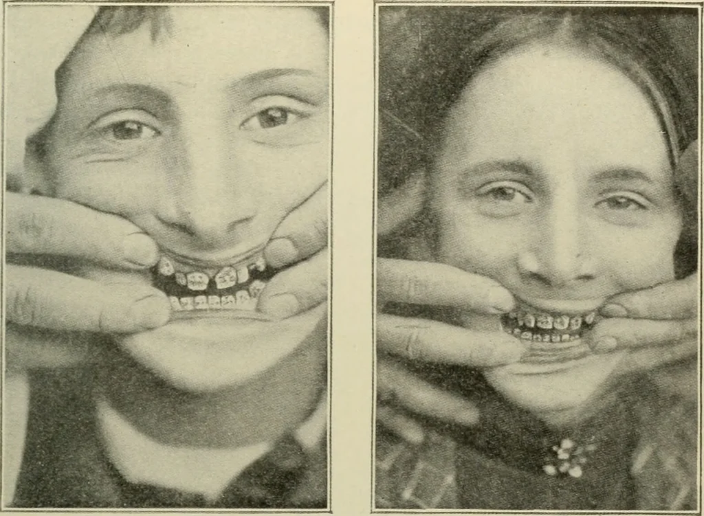 An illustration from Diseases of infancy and childhood, their dietetic, hygienic, and medical treatment : a text-book designed for practitioners and students in medicine / By Louis Fischer., 1910, leaf 401