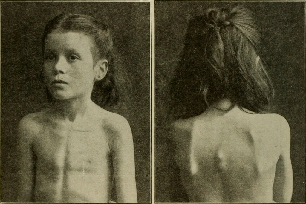 An illustration from Diseases of infancy and childhood, their dietetic, hygienic, and medical treatment : a text-book designed for practitioners and students in medicine / By Louis Fischer., 1910, leaf 410