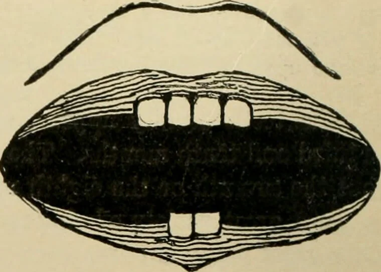 An illustration from Diseases of infancy and childhood, their dietetic, hygienic, and medical treatment : a text-book designed for practitioners and students in medicine / By Louis Fischer., 1910, leaf 42