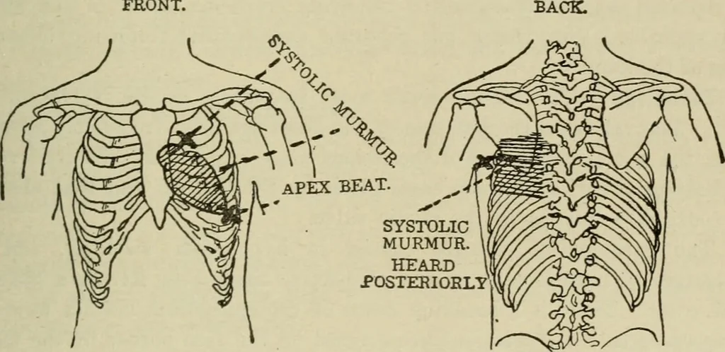 An illustration from Diseases of infancy and childhood, their dietetic, hygienic, and medical treatment : a text-book designed for practitioners and students in medicine / By Louis Fischer., 1910, leaf 427