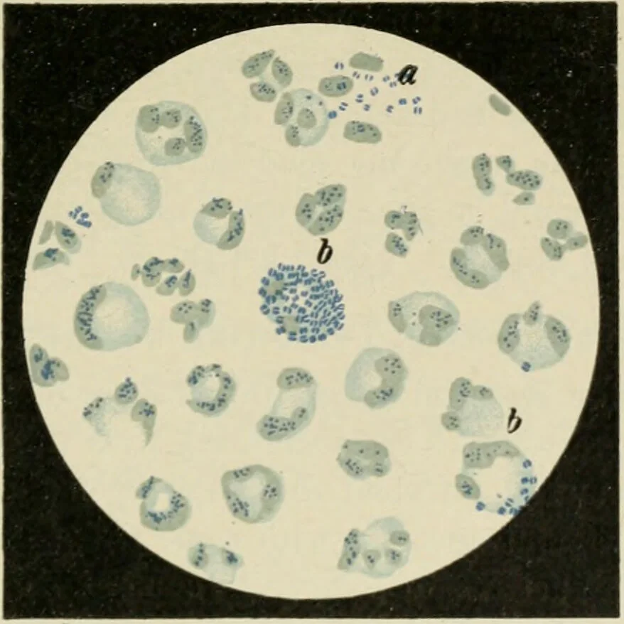 An illustration from Diseases of infancy and childhood, their dietetic, hygienic, and medical treatment : a text-book designed for practitioners and students in medicine / By Louis Fischer., 1910, leaf 457