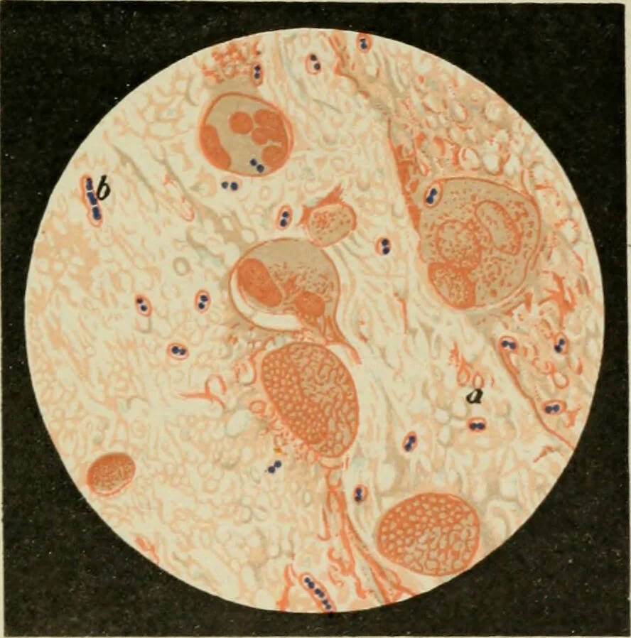 An illustration from Diseases of infancy and childhood, their dietetic, hygienic, and medical treatment : a text-book designed for practitioners and students in medicine / By Louis Fischer., 1910, leaf 515