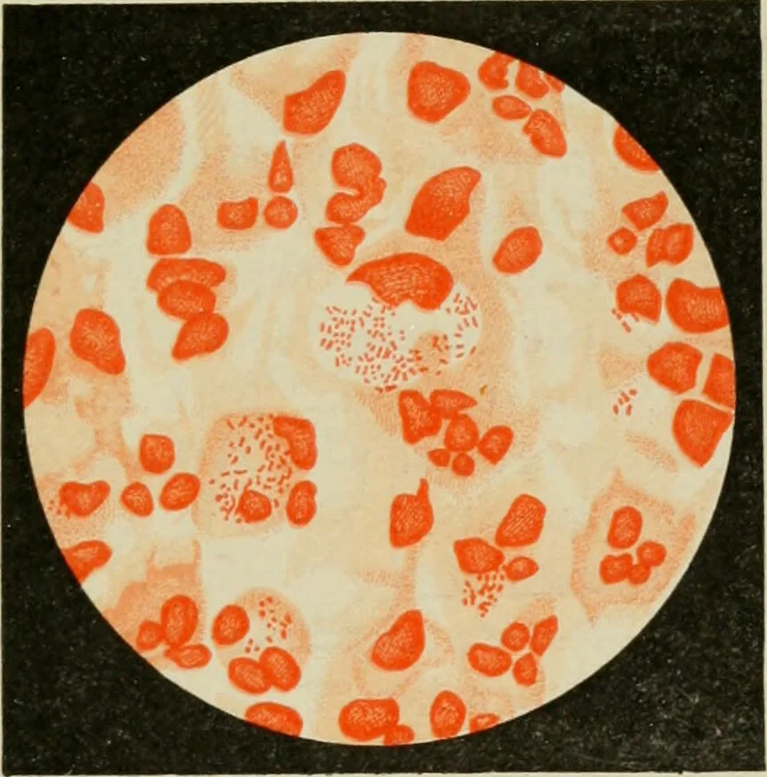 An illustration from Diseases of infancy and childhood, their dietetic, hygienic, and medical treatment : a text-book designed for practitioners and students in medicine / By Louis Fischer., 1910, leaf 537