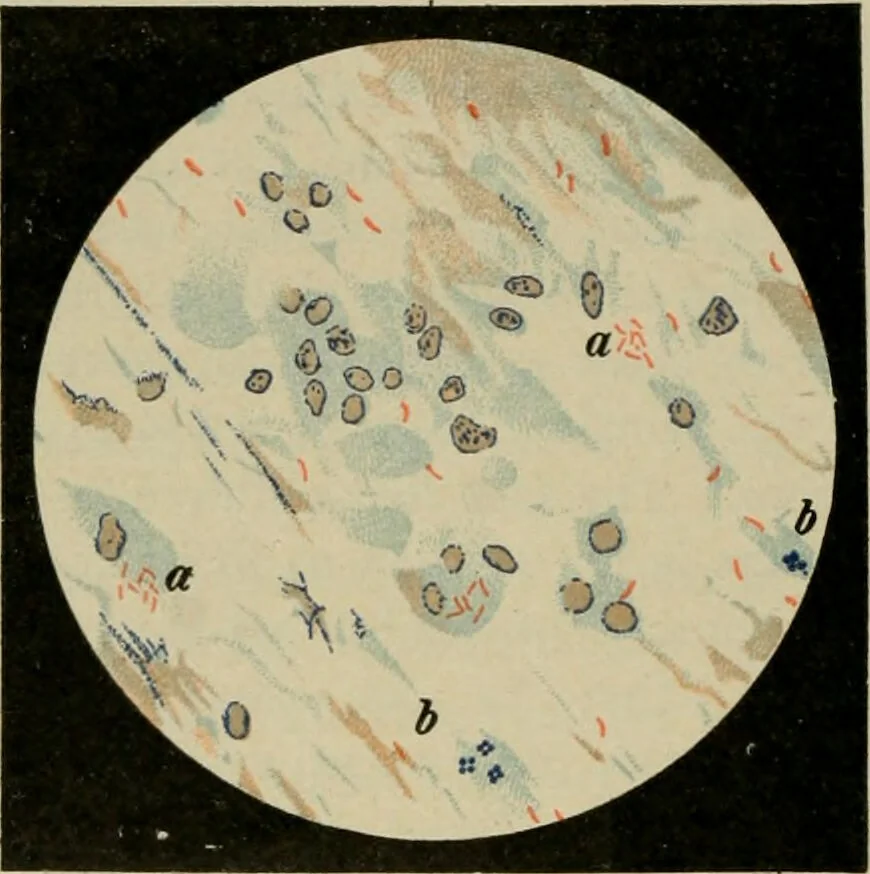 An illustration from Diseases of infancy and childhood, their dietetic, hygienic, and medical treatment : a text-book designed for practitioners and students in medicine / By Louis Fischer., 1910, leaf 578