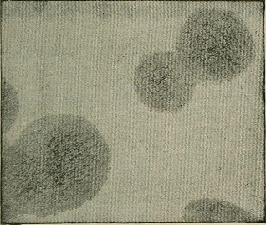 An illustration from Diseases of infancy and childhood, their dietetic, hygienic, and medical treatment : a text-book designed for practitioners and students in medicine / By Louis Fischer., 1910, leaf 607