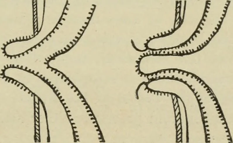 An illustration from Diseases of infancy and childhood, their dietetic, hygienic, and medical treatment : a text-book designed for practitioners and students in medicine / By Louis Fischer., 1910, leaf 69
