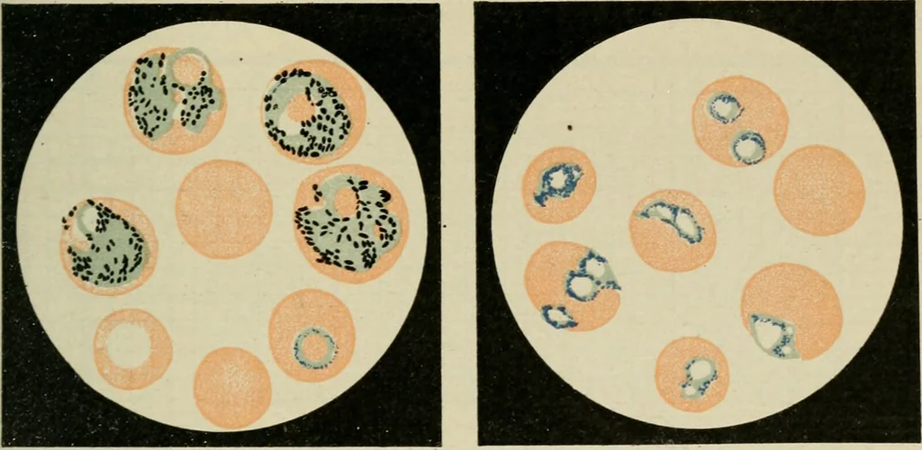 An illustration from Diseases of infancy and childhood, their dietetic, hygienic, and medical treatment : a text-book designed for practitioners and students in medicine / By Louis Fischer., 1910, leaf 779
