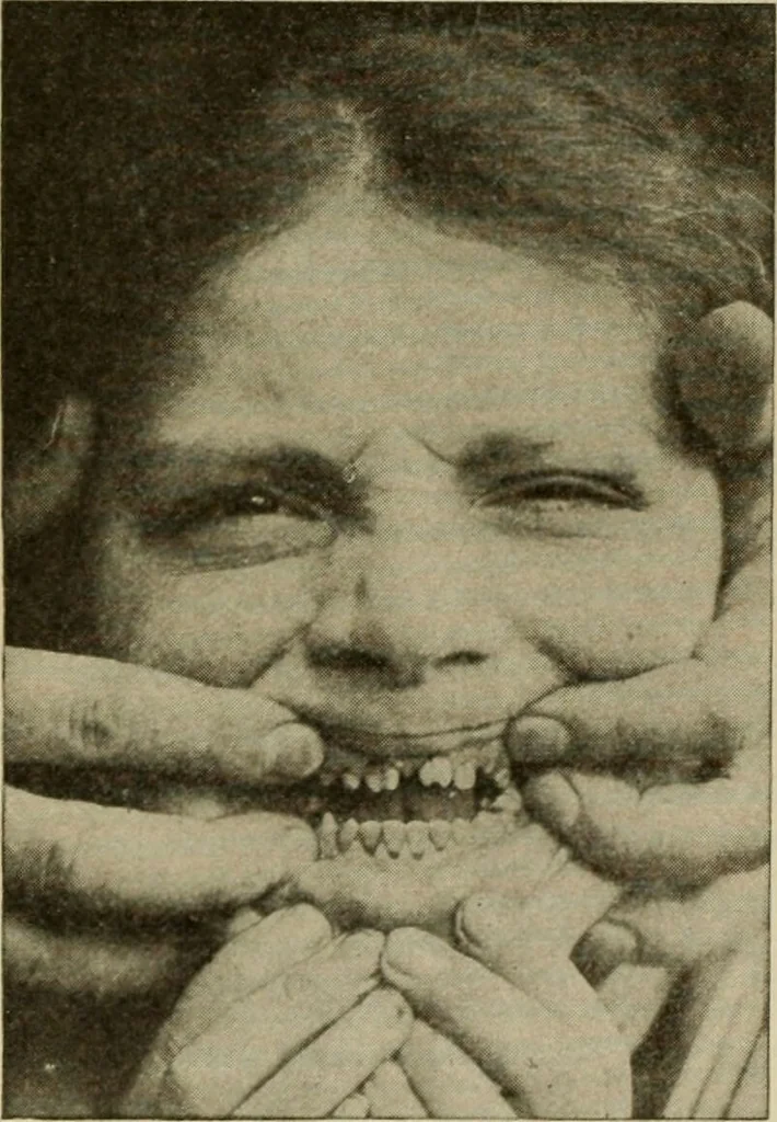 An illustration from Diseases of infancy and childhood, their dietetic, hygienic, and medical treatment : a text-book designed for practitioners and students in medicine / By Louis Fischer., 1910, leaf 794
