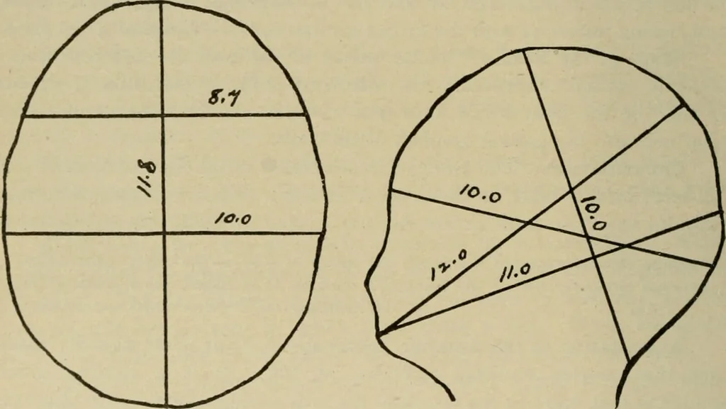 An illustration from Diseases of infancy and childhood, their dietetic, hygienic, and medical treatment : a text-book designed for practitioners and students in medicine / By Louis Fischer., 1910, leaf 854