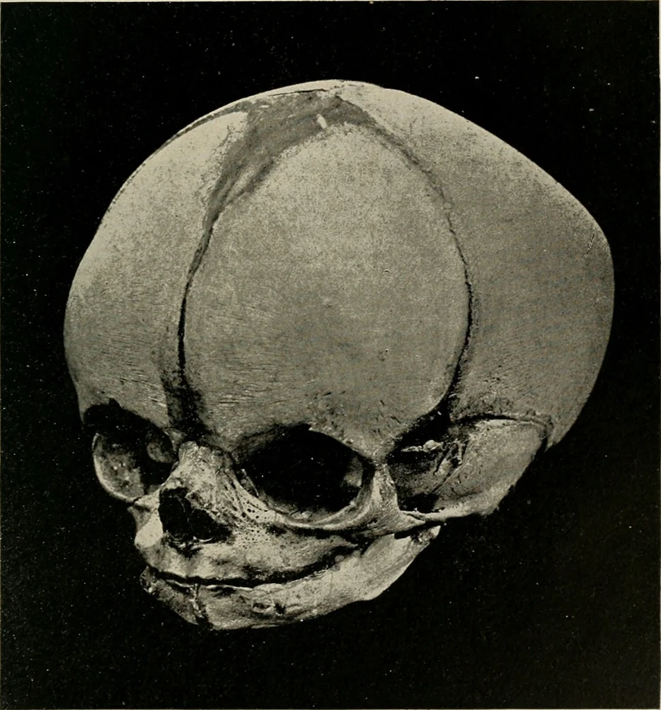 An illustration from Diseases of infancy and childhood, their dietetic, hygienic, and medical treatment : a text-book designed for practitioners and students in medicine / By Louis Fischer., 1910, leaf 857