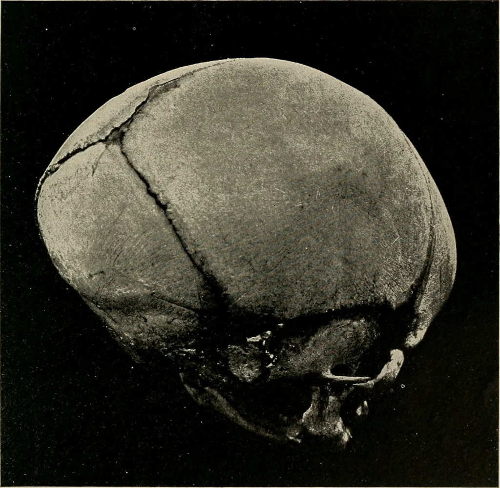 An illustration from Diseases of infancy and childhood, their dietetic, hygienic, and medical treatment : a text-book designed for practitioners and students in medicine / By Louis Fischer., 1910, leaf 861