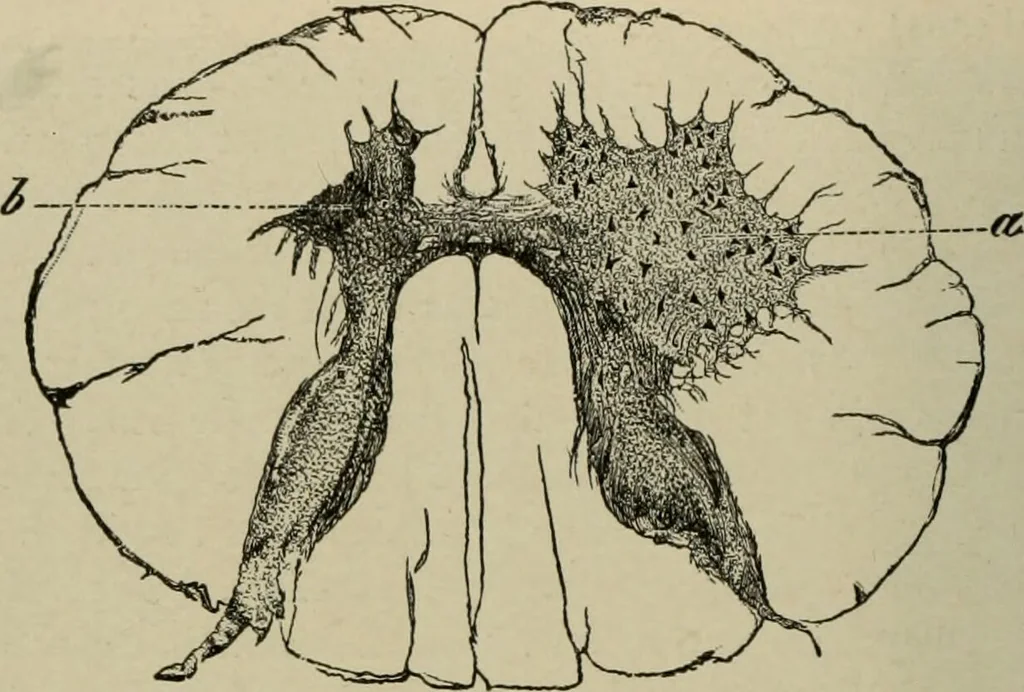 An illustration from Diseases of infancy and childhood, their dietetic, hygienic, and medical treatment : a text-book designed for practitioners and students in medicine / By Louis Fischer., 1910, leaf 894