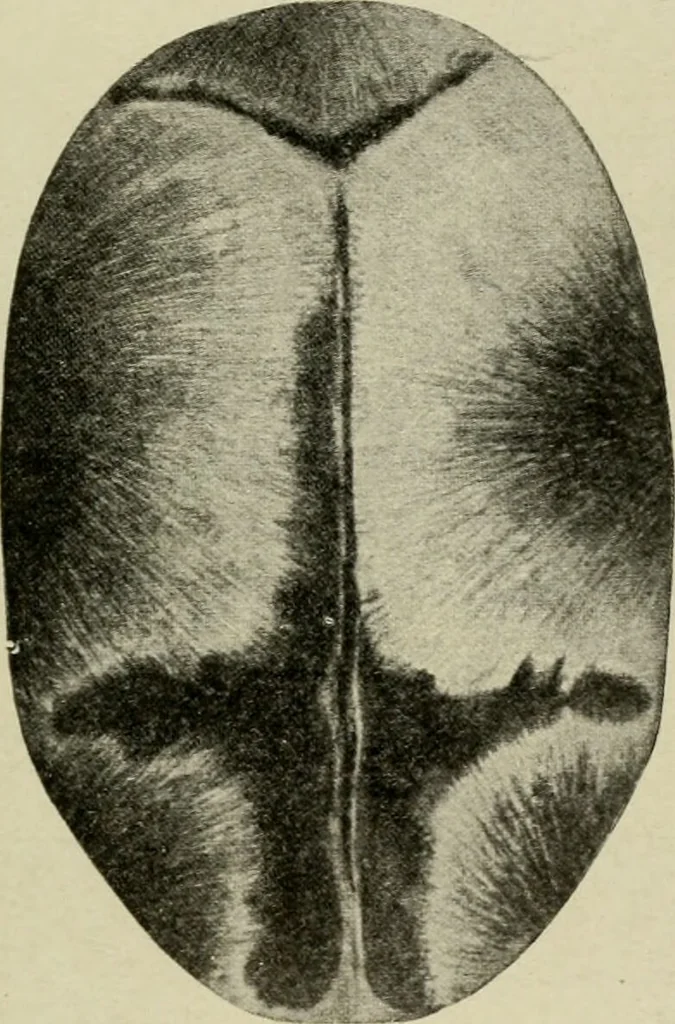 An illustration from Diseases of infancy and childhood, their dietetic, hygienic, and medical treatment : a text-book designed for practitioners and students in medicine / By Louis Fischer., 1910, leaf 899
