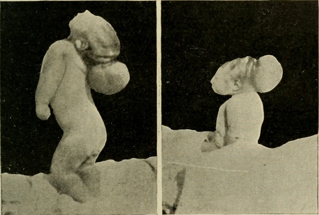 An illustration from Diseases of infancy and childhood, their dietetic, hygienic, and medical treatment : a text-book designed for practitioners and students in medicine / By Louis Fischer., 1910, leaf 901