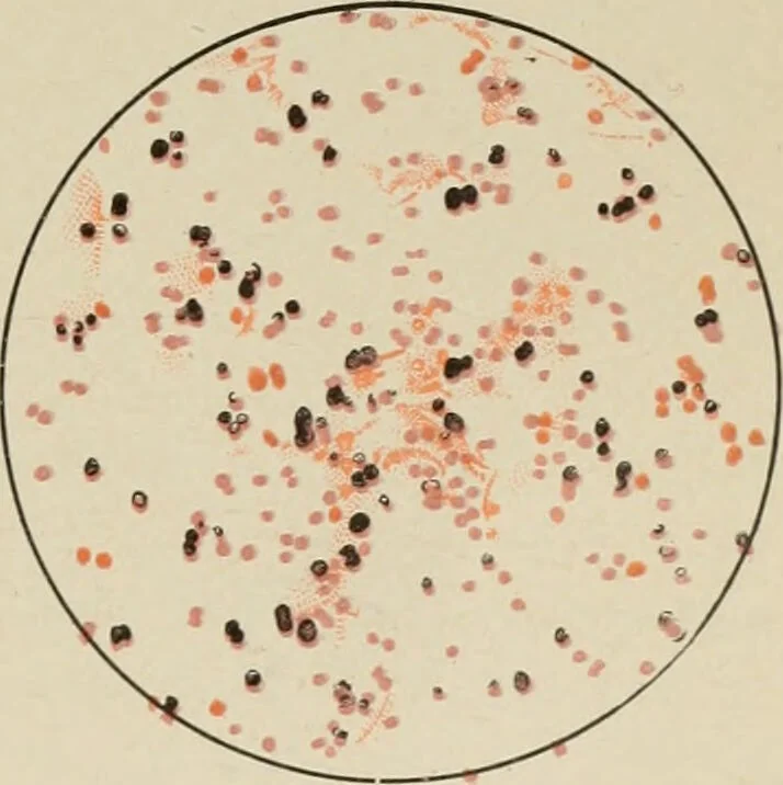 An illustration from Diseases of infancy and childhood, their dietetic, hygienic, and medical treatment : a text-book designed for practitioners and students in medicine / By Louis Fischer., 1910, leaf 909