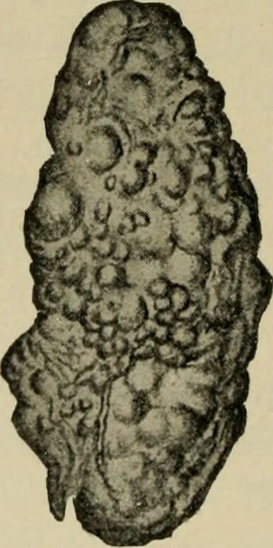 An illustration from Diseases of infancy and childhood, their dietetic, hygienic, and medical treatment : a text-book designed for practitioners and students in medicine / By Louis Fischer., 1910, leaf 96