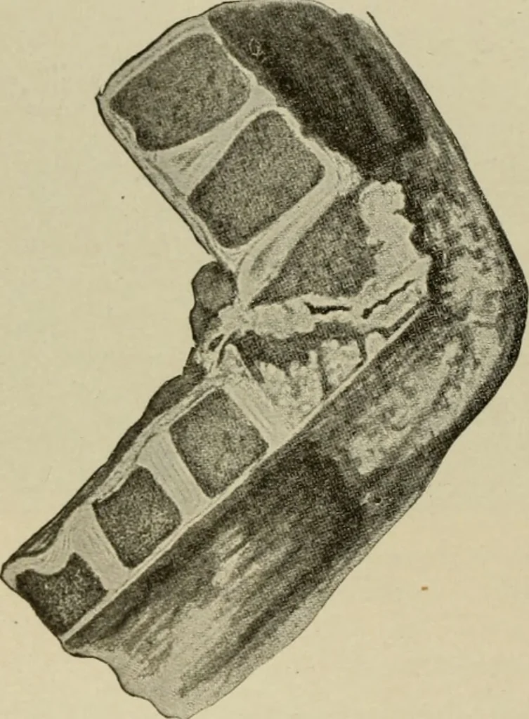 An illustration from Diseases of infancy and childhood, their dietetic, hygienic, and medical treatment : a text-book designed for practitioners and students in medicine / By Louis Fischer., 1910, leaf 980