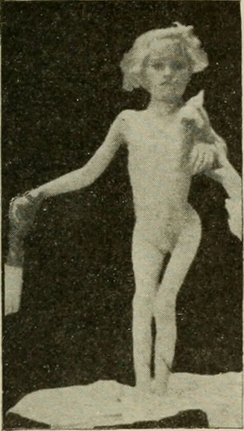 An illustration from Diseases of infancy and childhood, their dietetic, hygienic, and medical treatment : a text-book designed for practitioners and students in medicine / By Louis Fischer., 1910, leaf 989