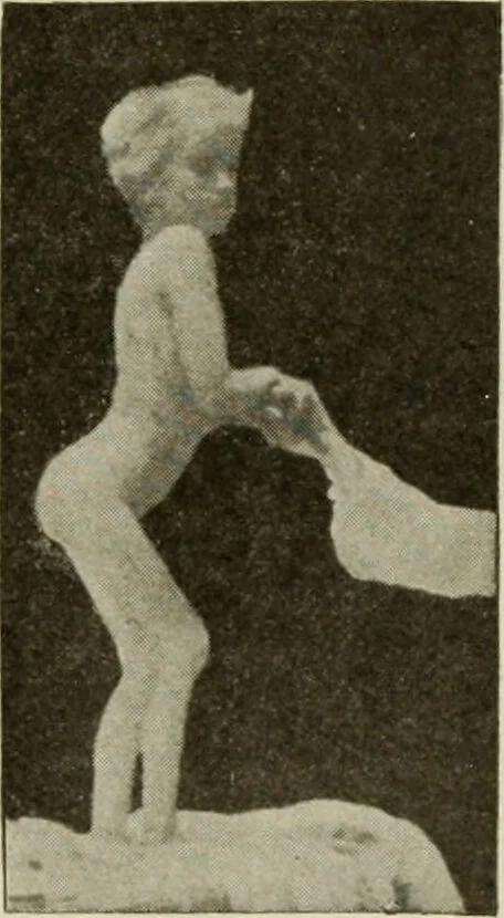 An illustration from Diseases of infancy and childhood, their dietetic, hygienic, and medical treatment : a text-book designed for practitioners and students in medicine / By Louis Fischer., 1910, leaf 989