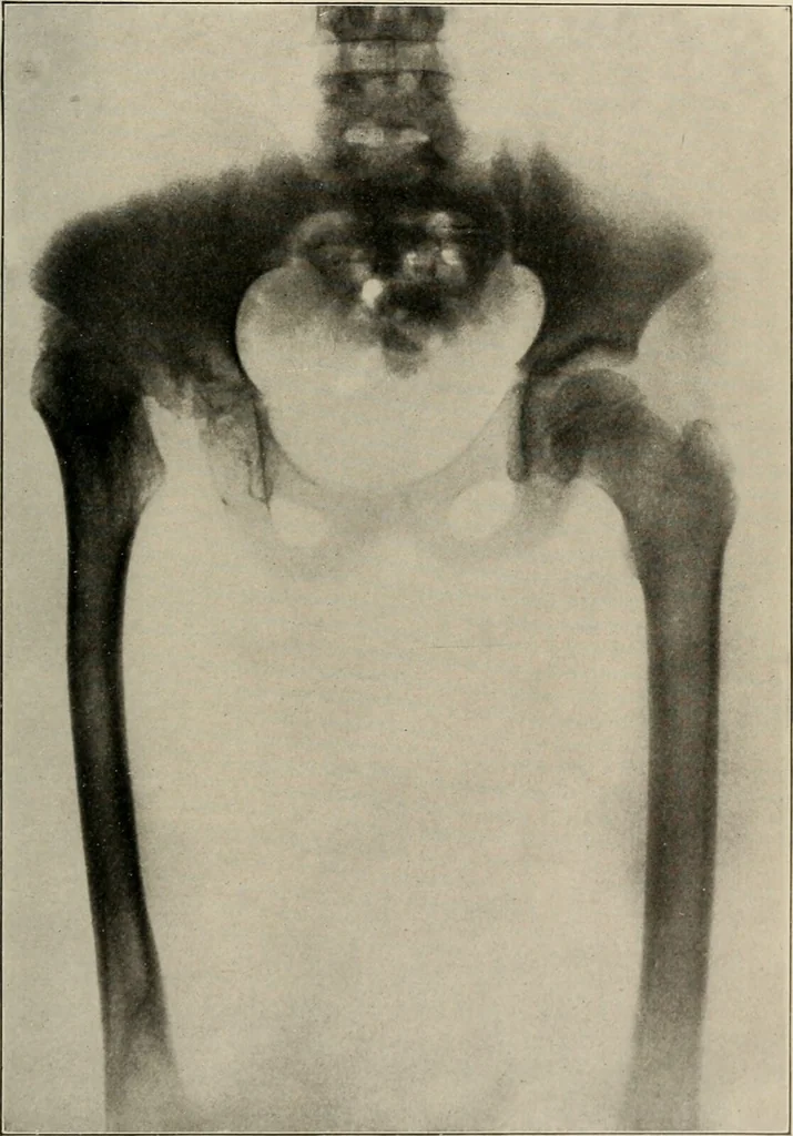 An illustration from Diseases of infancy and childhood, their dietetic, hygienic, and medical treatment : a text-book designed for practitioners and students in medicine / By Louis Fischer., 1910, leaf 991