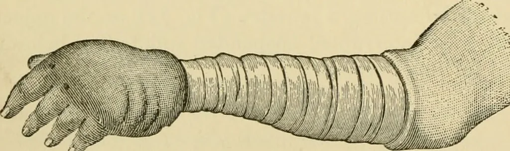 An illustration from Surgical technic; a text-book on operative surgery / by Fr. von Esmarch ... and E. Kowalzig ... translated by Professor Ludwig H. Grau ... and Willam N. Sullivan ... edited by Nicholas Senn ... With fourteen hundred and ninety-seven illustrations and fifteen colored plates., 1901, leaf 112