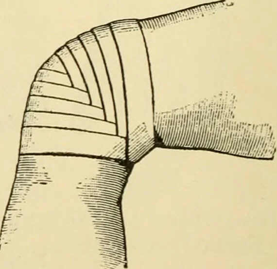 An illustration from Surgical technic; a text-book on operative surgery / by Fr. von Esmarch ... and E. Kowalzig ... translated by Professor Ludwig H. Grau ... and Willam N. Sullivan ... edited by Nicholas Senn ... With fourteen hundred and ninety-seven illustrations and fifteen colored plates., 1901, leaf 116